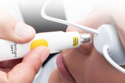 Lumenis Optilight IPL