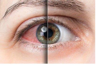Dry eye before and after treatment